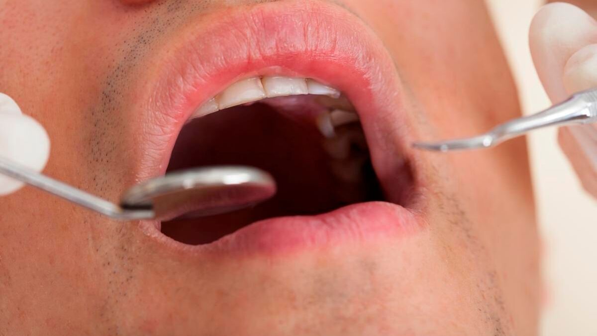 Zeichen für Mundhöhlenkrebs rechtzeitig erkennen