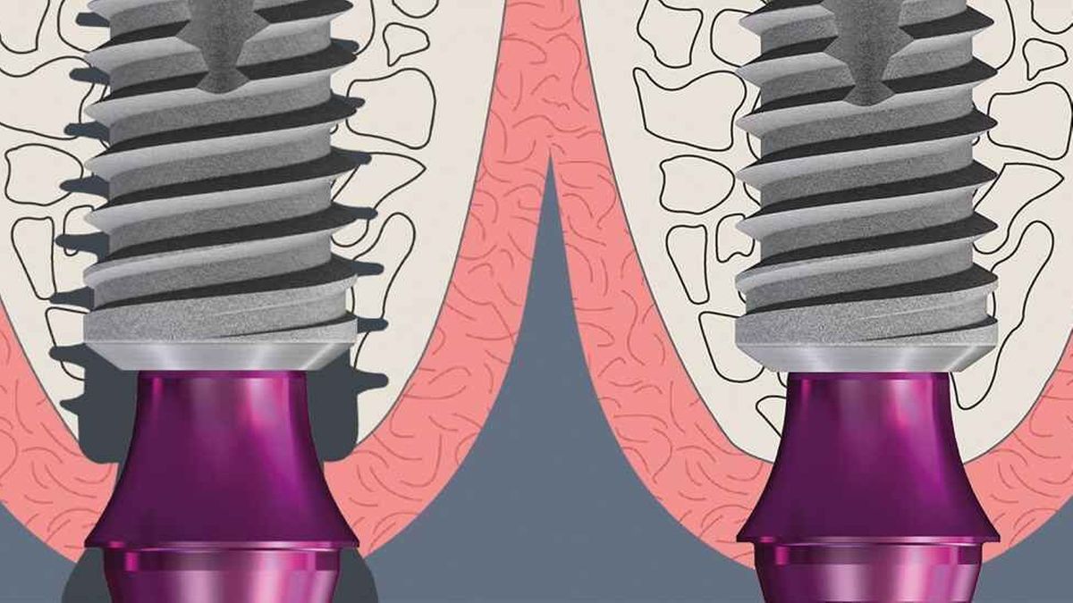 Osseointegration mit dem Bone Growth Concept